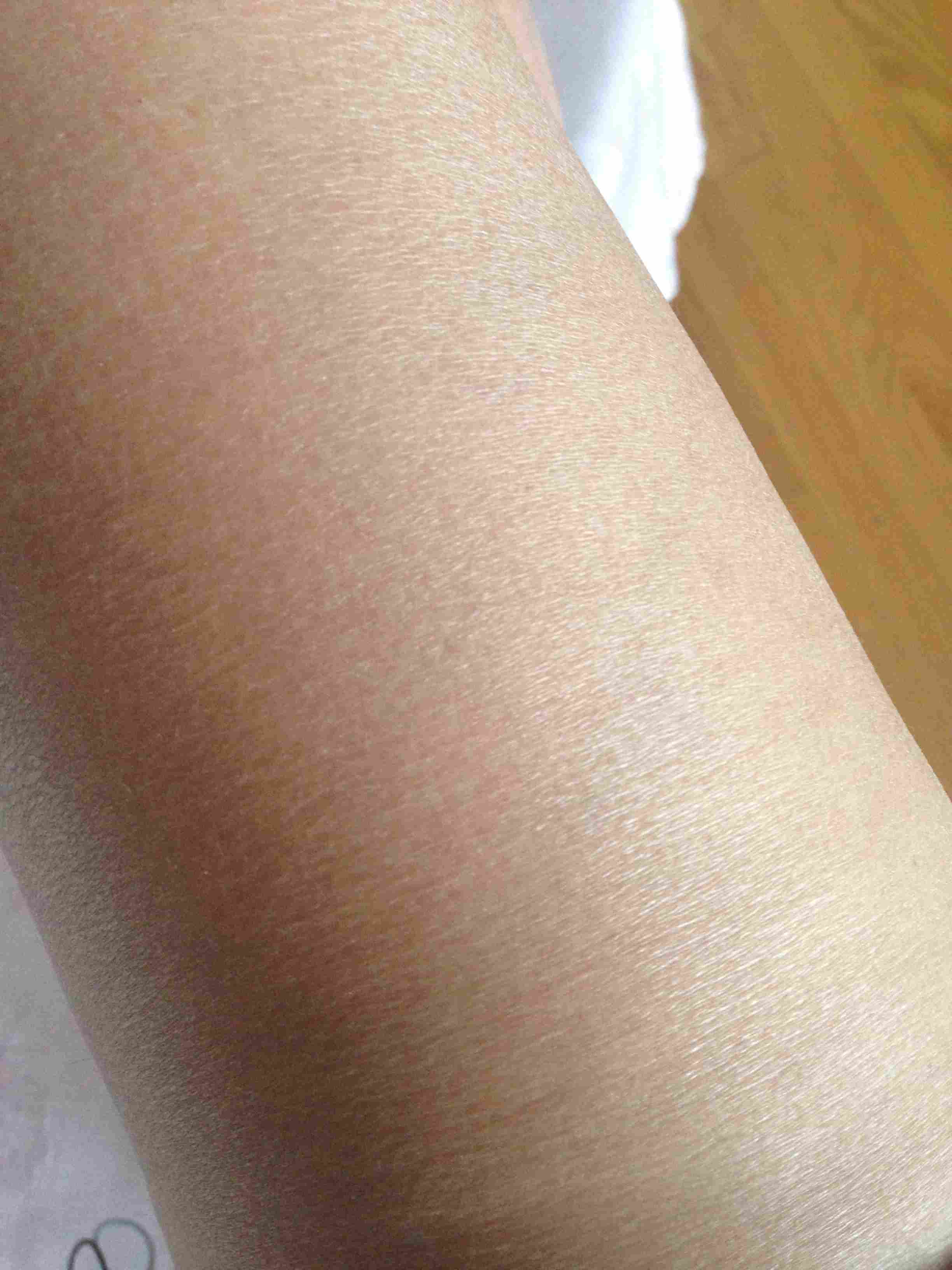 Cellulite gone in two weeks after commensing Inclined Bed Therapy (IBT)